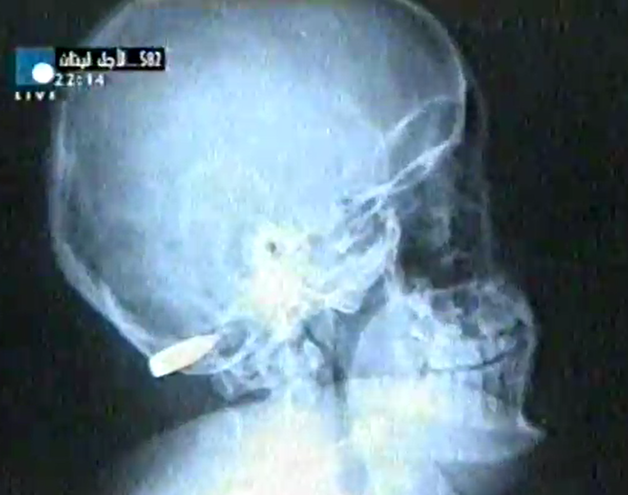 Libanon, Lara Leitner, Kopfschuss, Röntgen